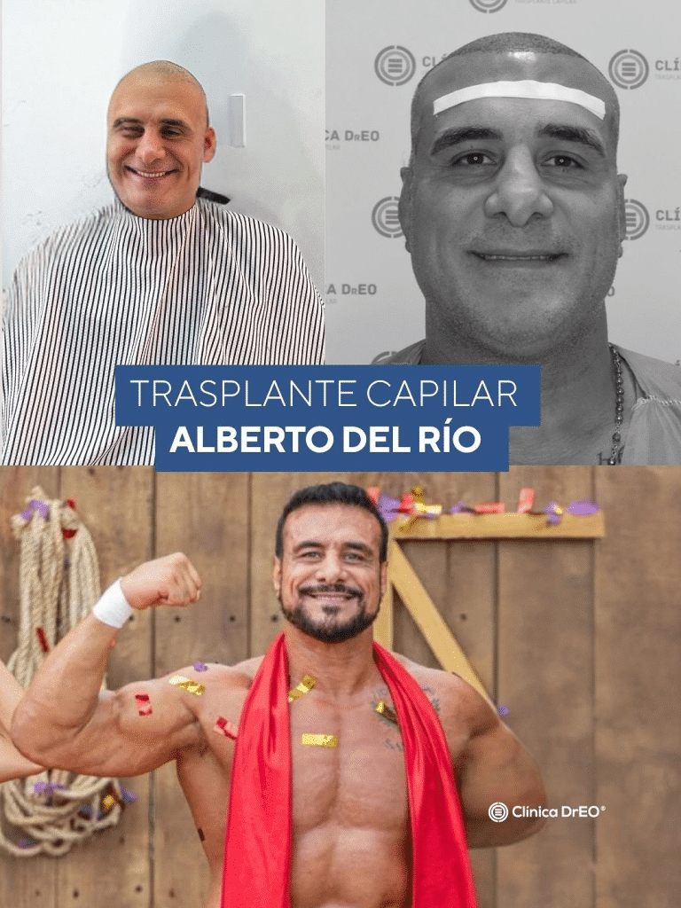 postinjerto capilar de Alberto del Río