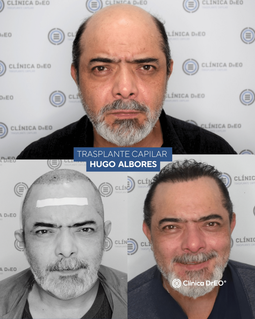 injerto capilar resultados clinica dreo