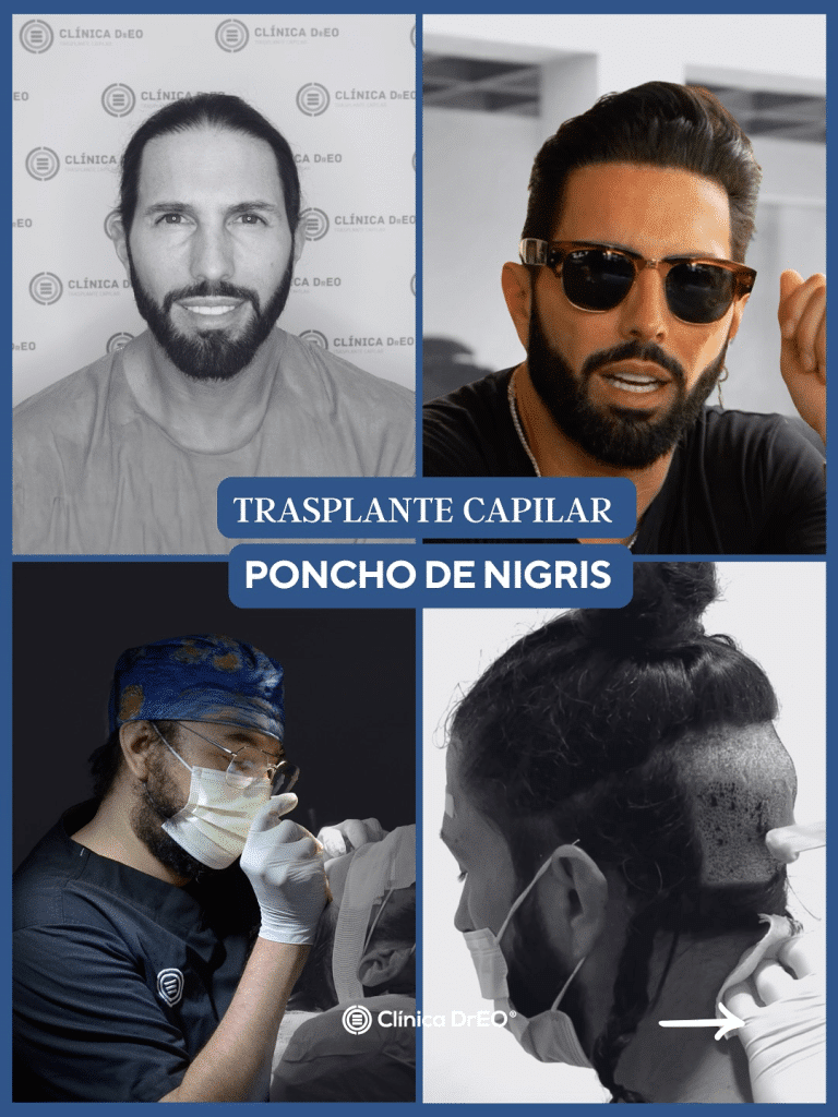 postinjerto capilar de Poncho Denigris 