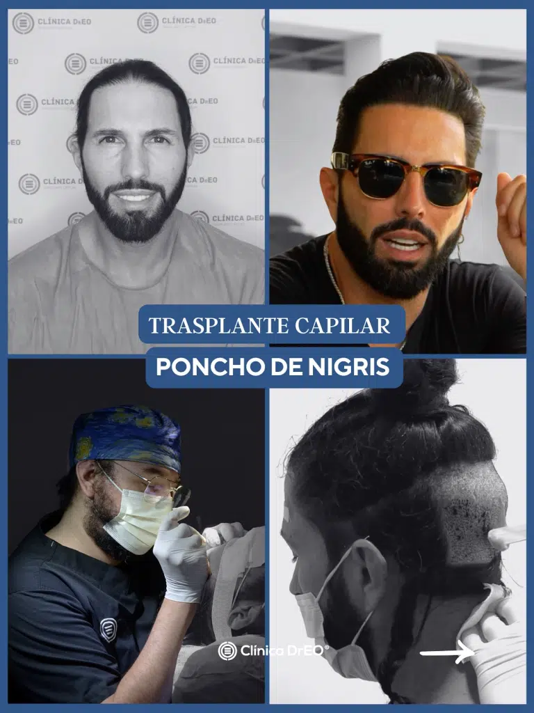 Postinjerto capilar: cuidados esenciales para una recuperación exitosa 1 postinjerto capilar de Poncho Denigris