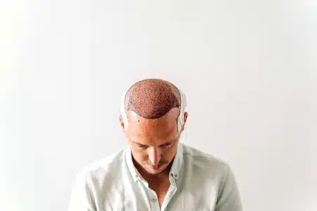 postinjerto capilar con evolución natural después de trasplante de cabello
