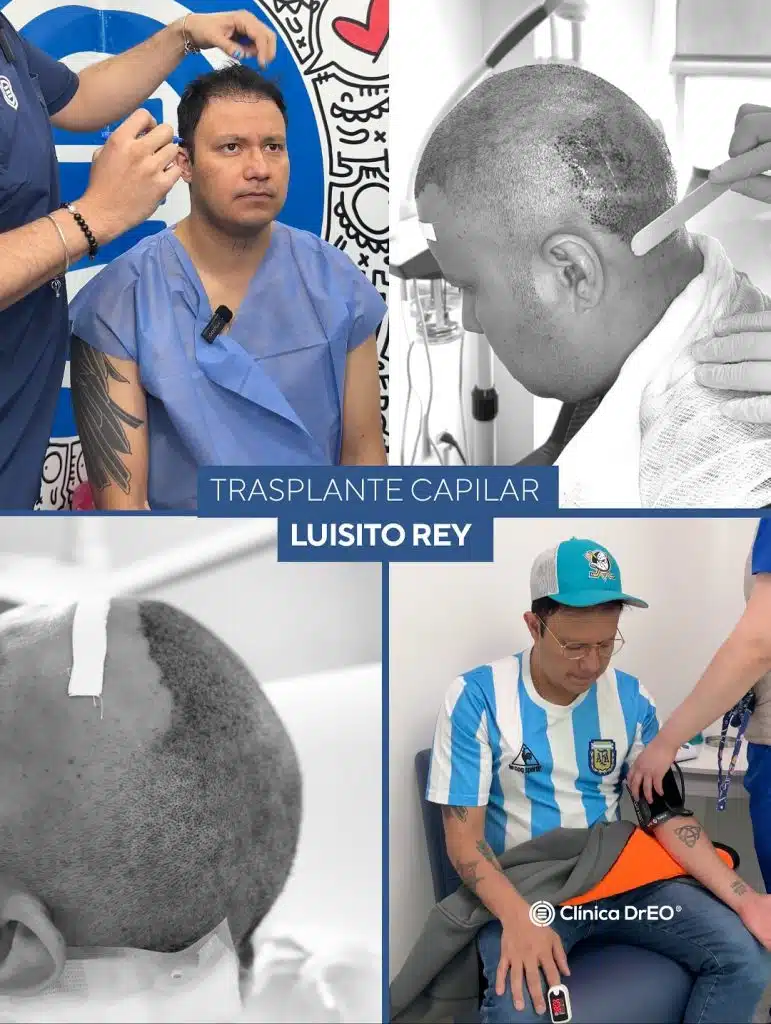 Postinjerto capilar: cuidados esenciales para una recuperación exitosa 2 postinjerto capilar de Luisito Rey