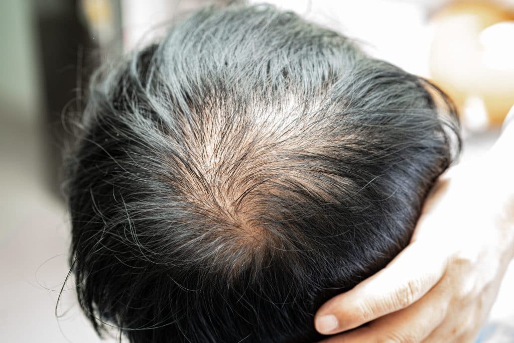alopecia en el centro de la cabeza de un hombre joven