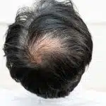 alopecia cicatrical en la parte central de la cabeza