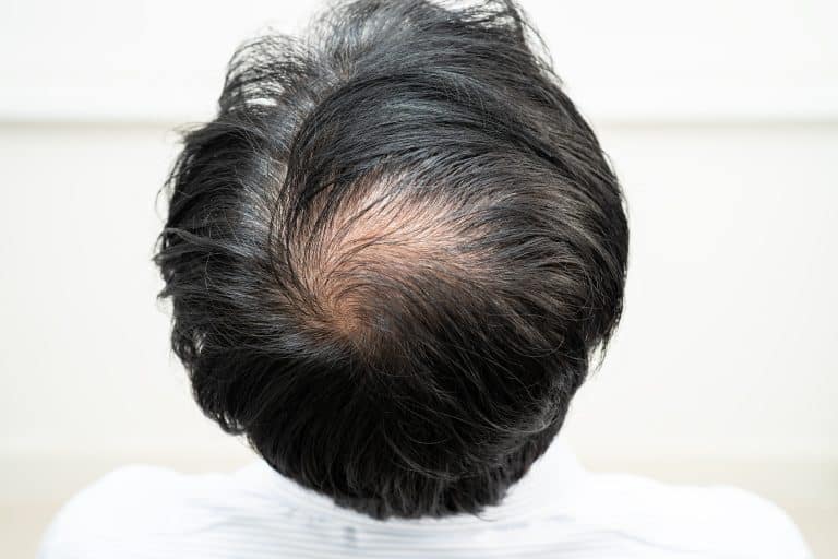 alopecia cicatrical en la parte central de la cabeza