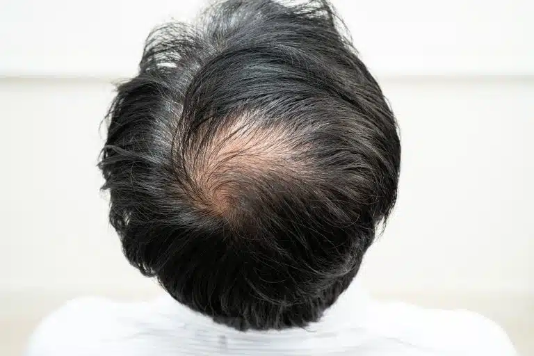 alopecia cicatrical en la parte central de la cabeza