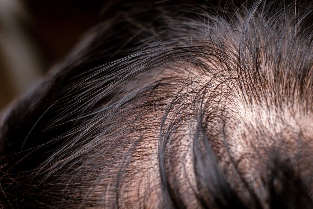 alopecia cicatrical el adultos