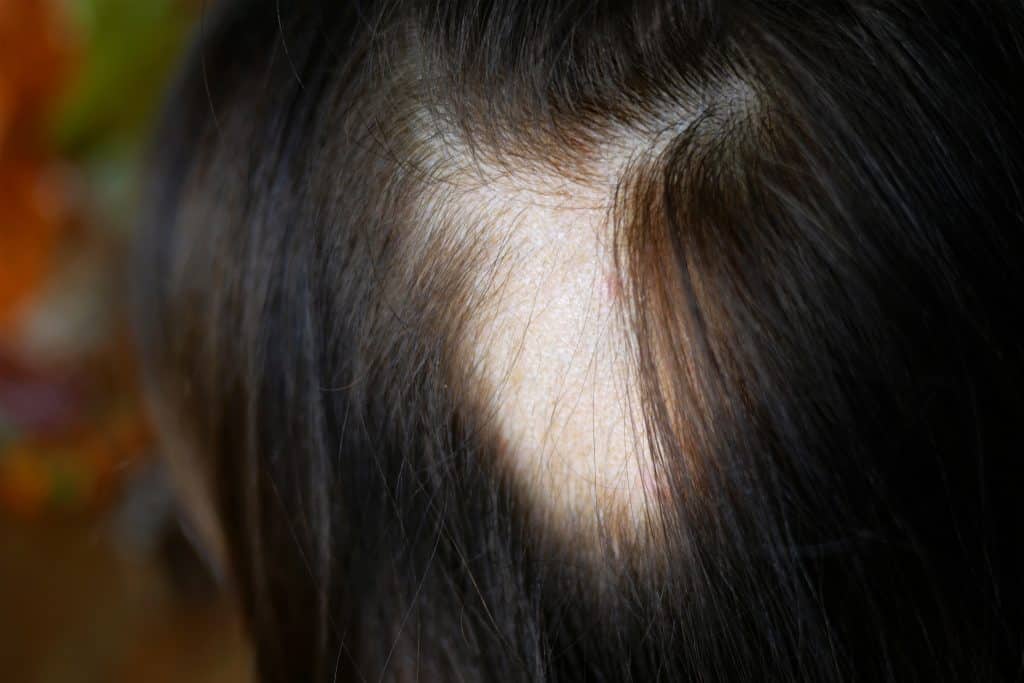 alopecia cicatrical en mujeres 