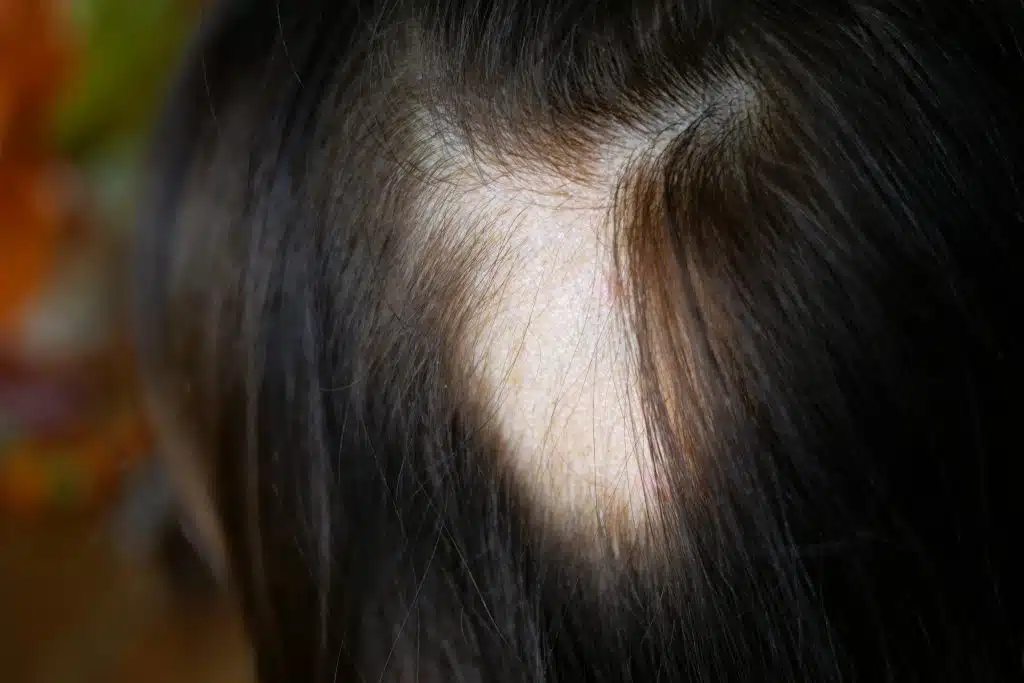 Alopecia cicatricial: lo que debes saber desde el primer momento 4 alopecia cicatrical en mujeres