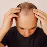 Hombre con entradas leves en la línea frontal del cabello