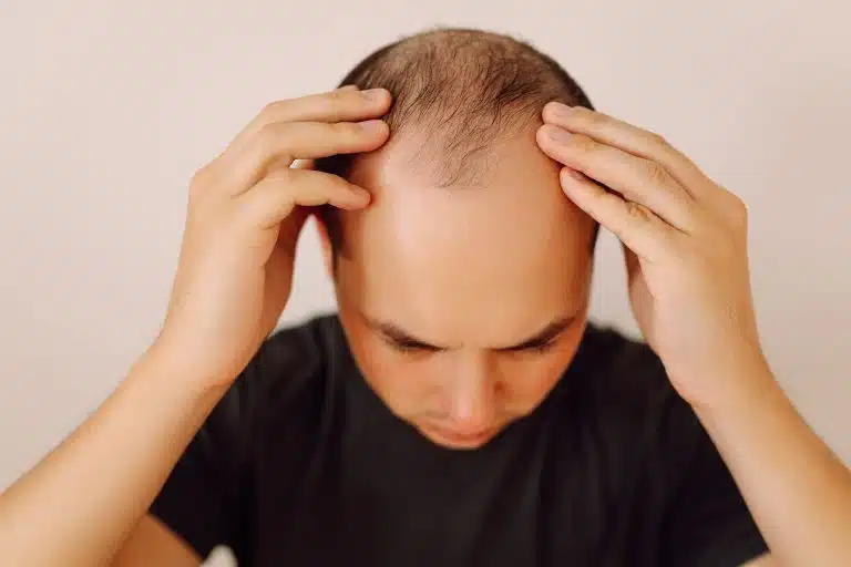 Hombre con entradas leves en la línea frontal del cabello