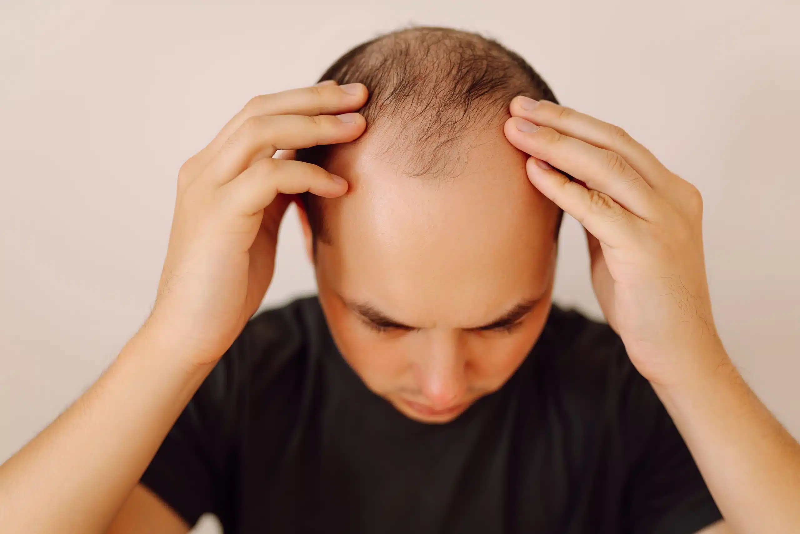 Hombre con entradas leves en la línea frontal del cabello