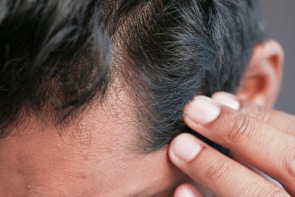 Hombre con entradas leves en la línea frontal del cabello en etapa temprana y cómo evitar que avancen
