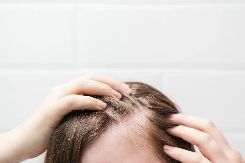 ¿Cómo evitar las entradas en el cabello? 3 Perfil de hombre con pérdida de densidad en las entradas y cuidados para evitar su avance