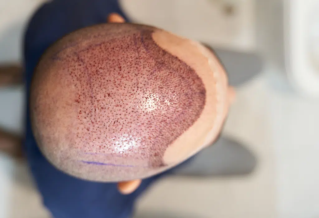 Entradas o coronilla: ¿qué zona conviene tratar primero con injerto capilar? 4 Resultado natural de un injerto capilar en entradas y coronilla después de la recuperación