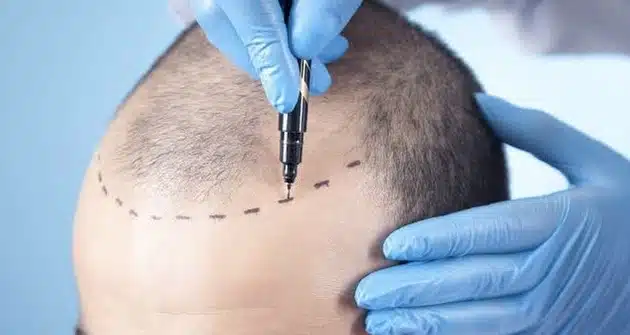 Diseño de la línea capilar considerando las proporciones del rostro del paciente.