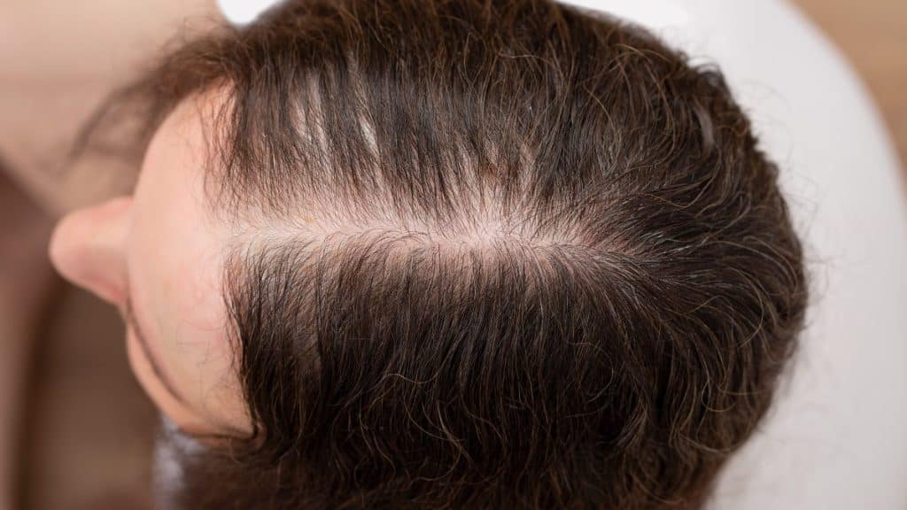 Ensanchamiento de la raya por pérdida de cabello femenina