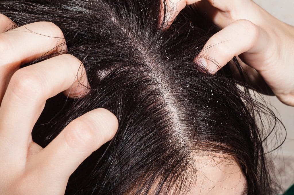 Dermatitis seborreica en el cuero cabelludo