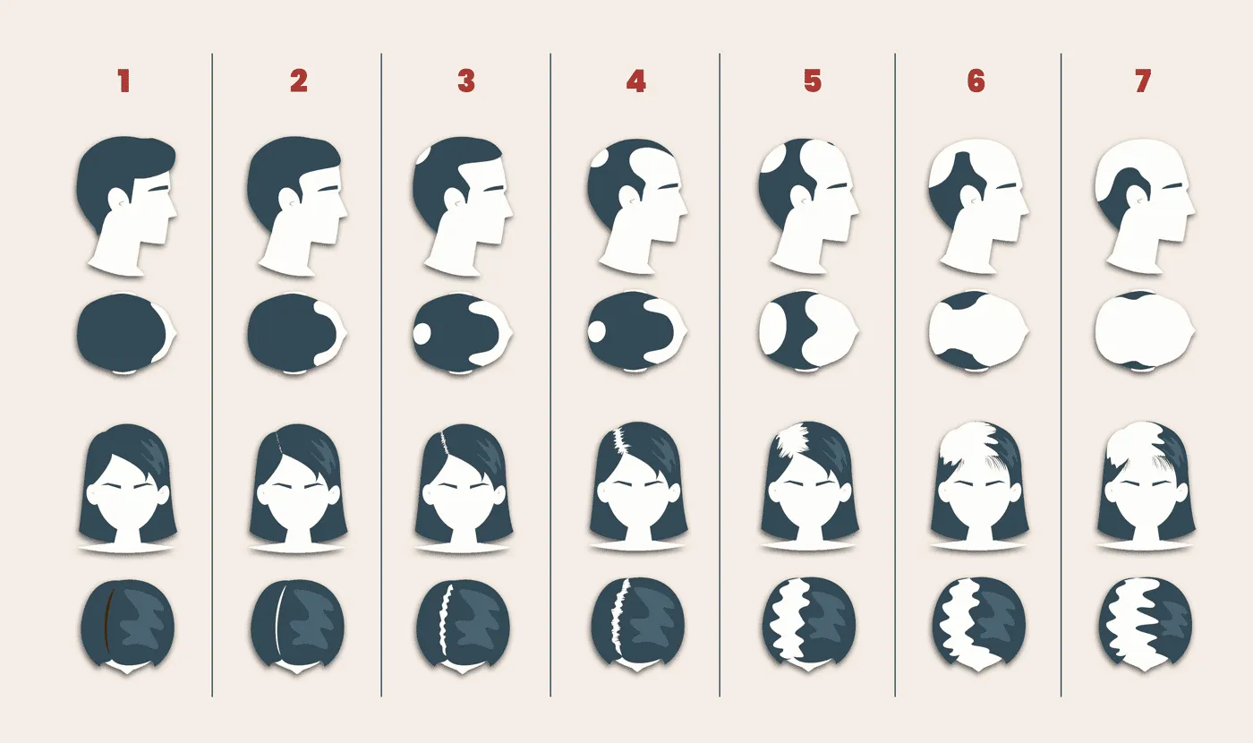 Cómo se utiliza la escala Norwood para evaluar la pérdida de cabello antes de un injerto capilar 1 Etapas de pérdida de cabello masculina según la escala Norwood