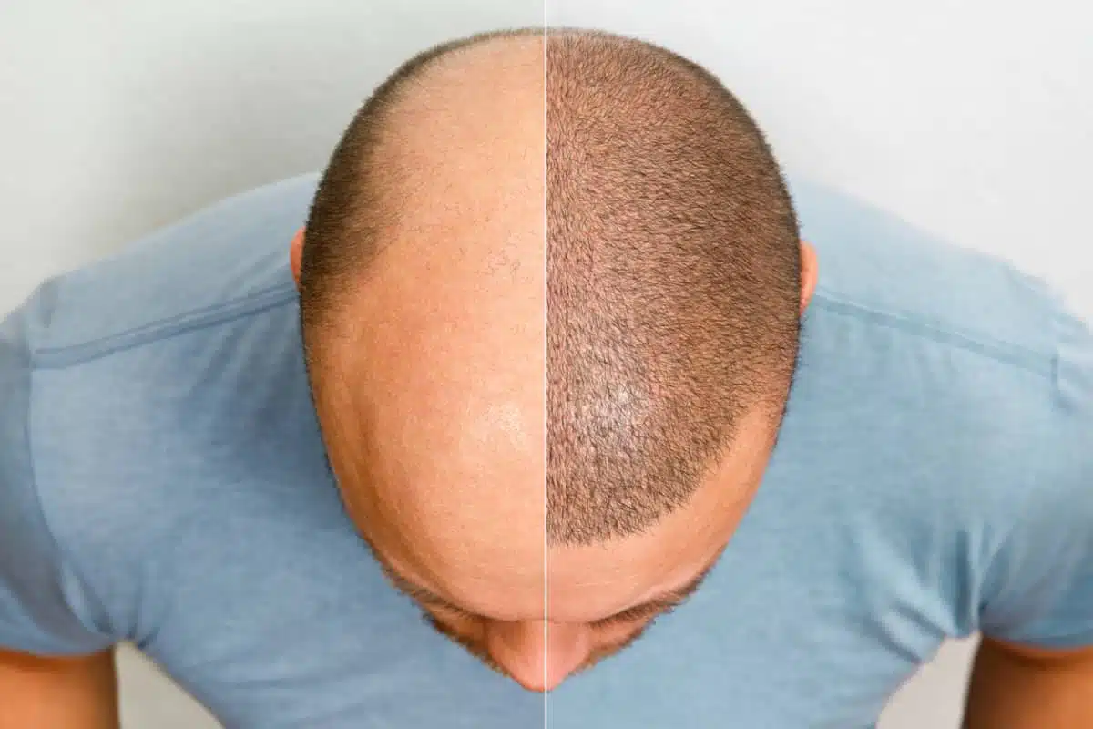 ¿Cuándo puedo cortarme el cabello después de un injerto capilar? 2 Recuperación de la zona donante después de un trasplante capilar