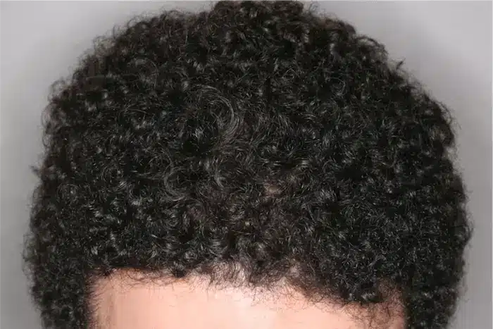 Injerto capilar en cabello rizado o afro: qué cambia en la técnica y la planificación 1 Planificación de trasplante capilar en cabello afro