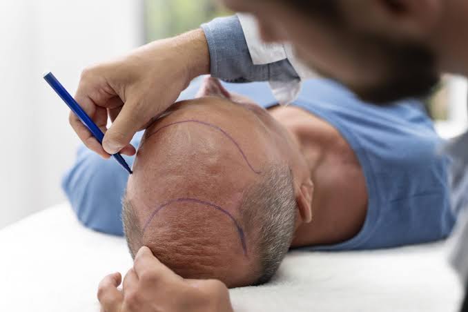  Cuidados postoperatorios después de un injerto capilar