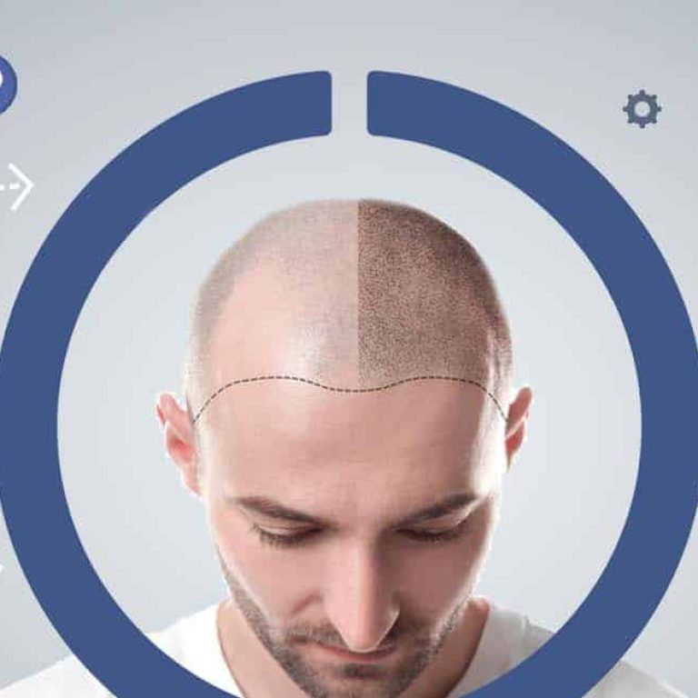 Consecuencias del injerto de cabello