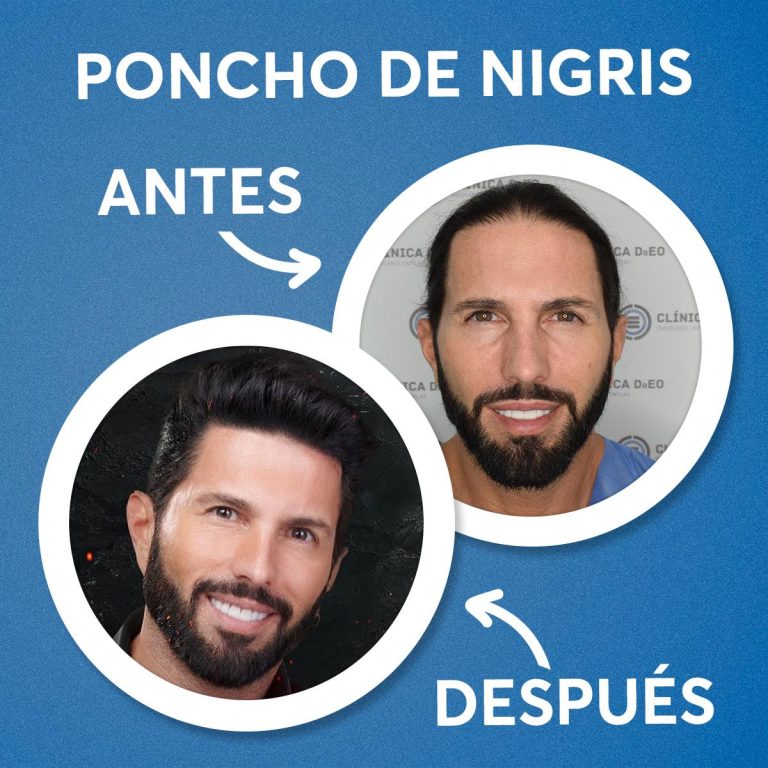 Cuanto cuesta un injerto de cabello