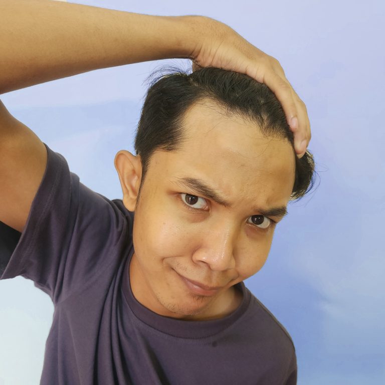 Por que se me cae el cabello si soy joven