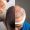 Trasplante capilar vs. Minoxidil