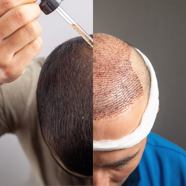 Trasplante capilar vs. Minoxidil