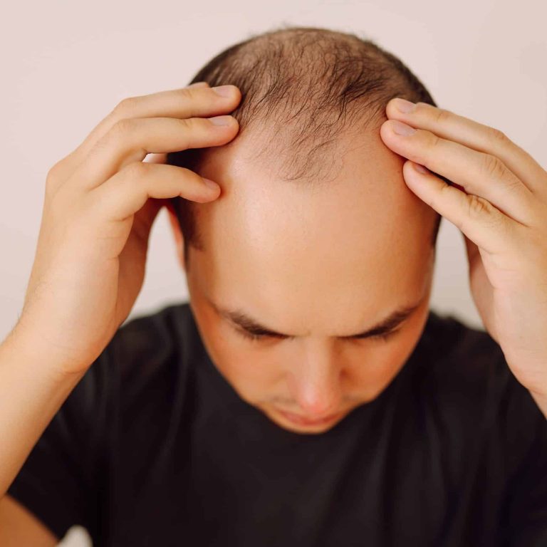 Hombre con entradas leves en la línea frontal del cabello